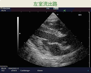 左室流出路