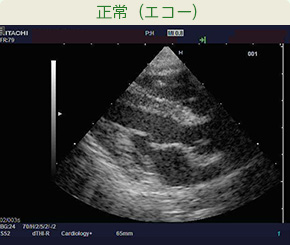正常（エコー）