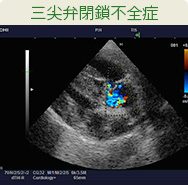 三尖弁閉鎖不全症