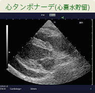 心タンポナーデ(心嚢水貯留)