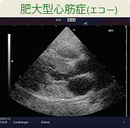 肥大型心筋症(エコー)