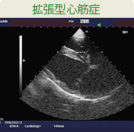 拡張型心筋症